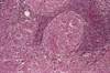 Cavity Volume and Proximity to Airway May Affect Tuberculosis Treatment Cavity Volume and Proximity to Airway May Affect Tuberculosis Treatment