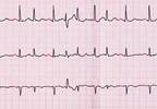 Pulmonary Arterial Hypertension Outcomes With Atrial Arrhythmia Pulmonary Arterial Hypertension Outcomes With Atrial Arrhythmia