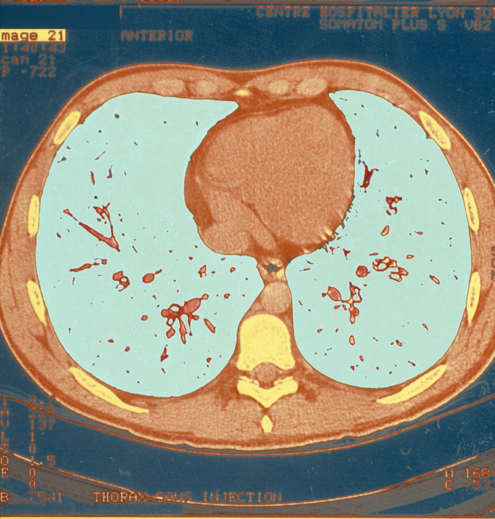 Azithromycin Reduced Pulmonary Exacerbation Risk in Cystic Fibrosis