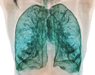 Greater Pi10 was associated with an increased risk for first chronic lower respiratory disease hospitalization. Greater Pi10 was associated with an increased risk for first chronic lower respiratory disease hospitalization.