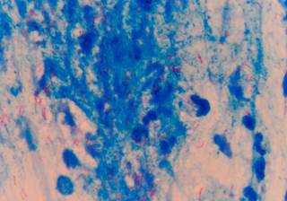 More than 70% of patients achieved sputum culture conversion with bedaquiline and/or delamanid treatment. More than 70% of patients achieved sputum culture conversion with bedaquiline and/or delamanid treatment.