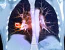 A Potential Algorithm for Diagnosing Cavitary Lung Diseases A Potential Algorithm for Diagnosing Cavitary Lung Diseases