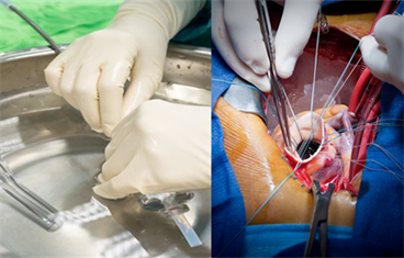 Transcatheter vs Surgical Aortic Valve Replacement in COPD Transcatheter vs Surgical Aortic Valve Replacement in COPD