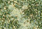 Stem Cell Therapy for RV Failure in PAH: Overview and Clinician Interview Stem Cell Therapy for RV Failure in PAH: Overview and Clinician Interview