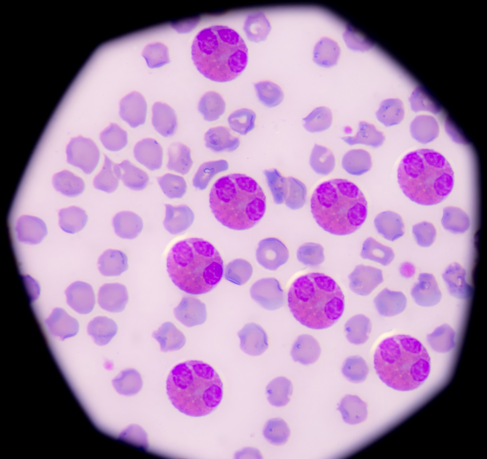 pneumonia-risk-in-severe-copd-linked-to-elevated-eosinophil-count