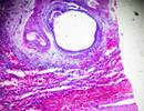 Expert Consensus on Chronic Hypersensitivity Pneumonitis Diagnostic Criteria Expert Consensus on Chronic Hypersensitivity Pneumonitis Diagnostic Criteria