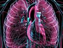 Survival Rates With Parenteral Prostanoids in Pulmonary Arterial Hypertension Survival Rates With Parenteral Prostanoids in Pulmonary Arterial Hypertension