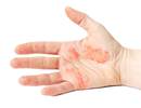 No Clinical Benefit Seen for Bath Emollients in Childhood Eczema No Clinical Benefit Seen for Bath Emollients in Childhood Eczema
