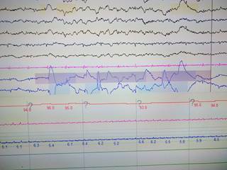 Portable sleep monitoring in hospitalized patients with heart failure may encourage early treatment initiation. Portable sleep monitoring in hospitalized patients with heart failure may encourage early treatment initiation.