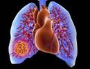 Copeptin May Serve as Prognostic Biomarker for Pulmonary Embolism Copeptin May Serve as Prognostic Biomarker for Pulmonary Embolism