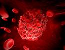 YEARS Criteria in Pulmonary Embolism Evaluation May Reduce Need for Imaging YEARS Criteria in Pulmonary Embolism Evaluation May Reduce Need for Imaging