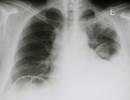 Talc Via Pleural Catheter vs Indwelling Pleural Catheter Alone for Pleurodesis Talc Via Pleural Catheter vs Indwelling Pleural Catheter Alone for Pleurodesis