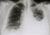 Talc Via Pleural Catheter vs Indwelling Pleural Catheter Alone for Pleurodesis Talc Via Pleural Catheter vs Indwelling Pleural Catheter Alone for Pleurodesis