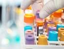Type 2 Biomarkers May Predict Exacerbations in Severe Refractory Asthma Type 2 Biomarkers May Predict Exacerbations in Severe Refractory Asthma