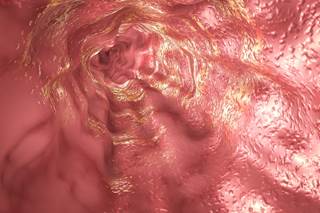 More robustly designed studies are needed to identify the exposures involved in the development of eosinophilic esophagitis. More robustly designed studies are needed to identify the exposures involved in the development of eosinophilic esophagitis.