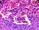 Hypersensitivity Pneumonitis Prevalence in an Insured US Population Hypersensitivity Pneumonitis Prevalence in an Insured US Population