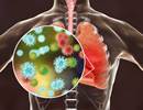 Budesonide Improved Epithelial Barrier Function in Asthma Budesonide Improved Epithelial Barrier Function in Asthma