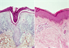 PAH-Associated Connective Tissue Diseases: A Case for Separating SSc, SLE PAH-Associated Connective Tissue Diseases: A Case for Separating SSc, SLE