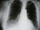 Potential COPD Pulmonary Vascular Phenotype Associated With Poor Outcomes Potential COPD Pulmonary Vascular Phenotype Associated With Poor Outcomes