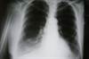 COPD and Obesity: Is There a Dose-Response Relationship in Nonsmokers? COPD and Obesity: Is There a Dose-Response Relationship in Nonsmokers?