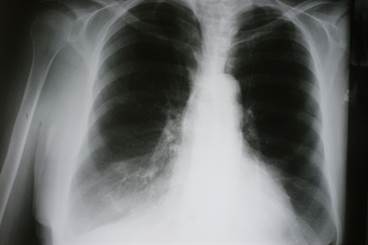 Collagen Degradation, Formation Elevated in Patients With Exacerbated COPD Collagen Degradation, Formation Elevated in Patients With Exacerbated COPD