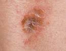 Montelukast Improved Symptoms in Angioedema-Predominant Chronic Spontaneous Urticaria Montelukast Improved Symptoms in Angioedema-Predominant Chronic Spontaneous Urticaria