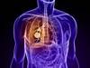 Non-Small Cell Lung Cancer Risk Increases With Chronic Inflammatory Lung Disease Non-Small Cell Lung Cancer Risk Increases With Chronic Inflammatory Lung Disease