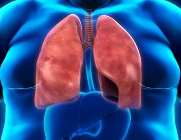 Age-Obesity Interaction in Pulmonary Arterial Hypertension Age-Obesity Interaction in Pulmonary Arterial Hypertension
