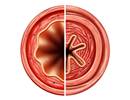 Tralokinumab Ineffective for Eosinophilic Airway Inflammation in Asthma Tralokinumab Ineffective for Eosinophilic Airway Inflammation in Asthma