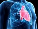Stroke, MI Risk Increased After Severe COPD Exacerbations Stroke, MI Risk Increased After Severe COPD Exacerbations