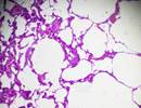 Clinical Effect of Emphysema in Individuals With HIV Clinical Effect of Emphysema in Individuals With HIV