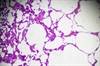 Clinical Effect of Emphysema in Individuals With HIV Clinical Effect of Emphysema in Individuals With HIV