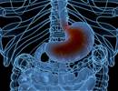 GERD and Nasal Symptoms Affect Bronchitis Symptom Severity in COPD GERD and Nasal Symptoms Affect Bronchitis Symptom Severity in COPD