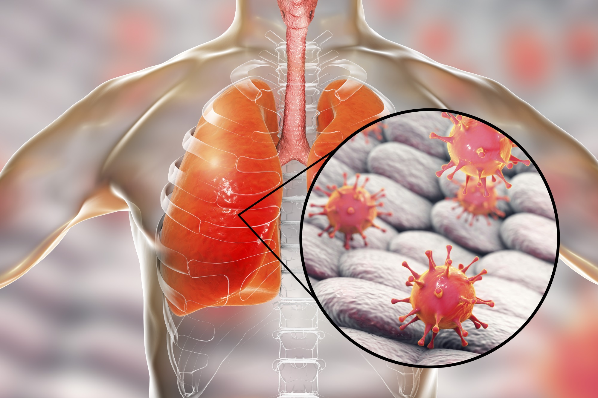 lungs-rlife-lunges-chronic-cough-mucus