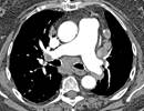 Pulmonary Arterial Stiffness Related to mPAP and Heart Rate in Idiopathic PAH Pulmonary Arterial Stiffness Related to mPAP and Heart Rate in Idiopathic PAH