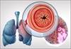 Unraveling the Relationship Between COPD and Stroke Unraveling the Relationship Between COPD and Stroke