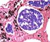 Lung Cancer Incidence in HIV Remains High Years After Smoking Cessation Lung Cancer Incidence in HIV Remains High Years After Smoking Cessation