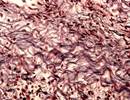 COPD Severity May Be Affected by Collagen Biomarker Remodeling COPD Severity May Be Affected by Collagen Biomarker Remodeling