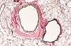 Early Pulmonary Vascular Disease Onset Risk in Adults Born Preterm Early Pulmonary Vascular Disease Onset Risk in Adults Born Preterm