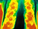 Theophylline Adjunct Therapy Fails to Reduce COPD Exacerbations Theophylline Adjunct Therapy Fails to Reduce COPD Exacerbations