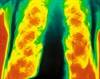 The Road to Precision Medicine in COPD Is Paved With Phenotypes The Road to Precision Medicine in COPD Is Paved With Phenotypes