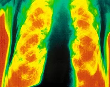 Small Reduction in Lung Function With Treatment De-Escalation in COPD Small Reduction in Lung Function With Treatment De-Escalation in COPD