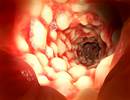 Comorbid Asthma Not Associated With Need for Surgery in Crohn Disease Comorbid Asthma Not Associated With Need for Surgery in Crohn Disease