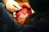 Is There an "Ideal" Cystic Fibrosis Candidate for Lung Transplantation? Is There an "Ideal" Cystic Fibrosis Candidate for Lung Transplantation?
