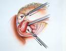 Laparoscopic Antireflux Surgery for Treating Idiopathic Pulmonary Fibrosis Laparoscopic Antireflux Surgery for Treating Idiopathic Pulmonary Fibrosis
