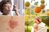 Relationship Between Atopic Disorders May Be Age Dependent Relationship Between Atopic Disorders May Be Age Dependent