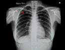 Incidence of Pulmonary Nodules Needed to Improve Screening Programs Incidence of Pulmonary Nodules Needed to Improve Screening Programs