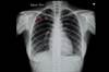 Incidence of Pulmonary Nodules Needed to Improve Screening Programs Incidence of Pulmonary Nodules Needed to Improve Screening Programs