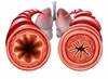 Gas Trapping Improved With Bronchial Thermoplasty in Severe Asthma Gas Trapping Improved With Bronchial Thermoplasty in Severe Asthma