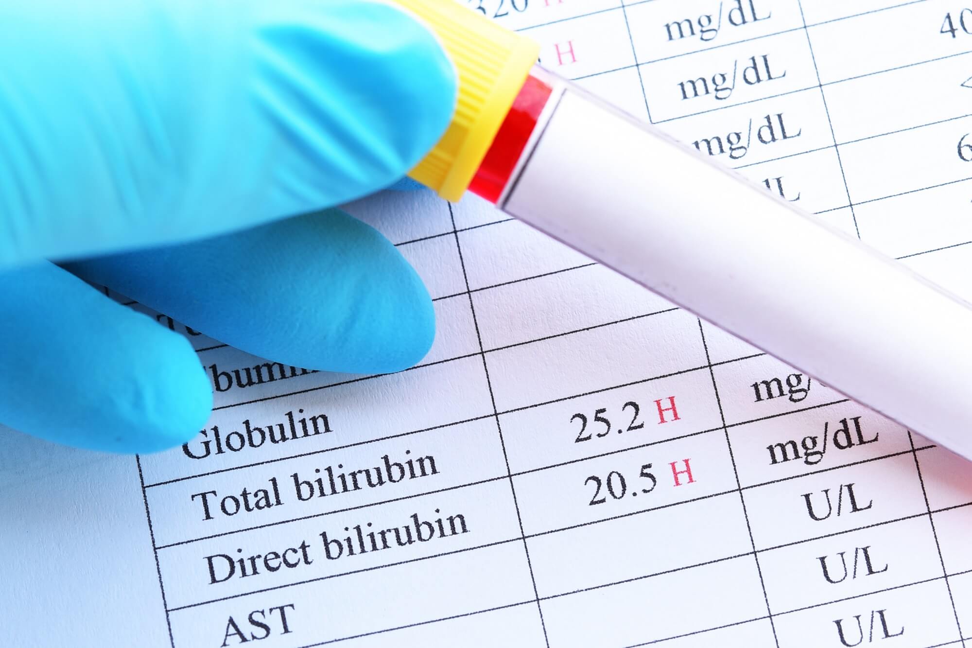 Serum Bilirubin Direct Treatment